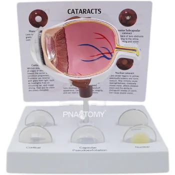 Свалящ се анатомическая модел на очите, катаракта, патологична модел на очната ябълка